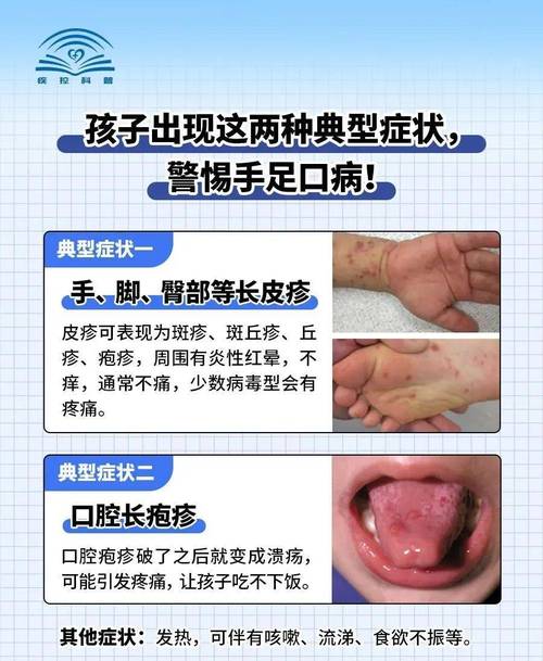 手足口病高发季，如何科学预防才能有效保护孩子健康？-图2